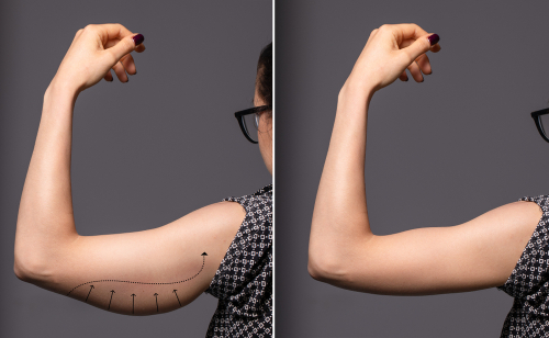 immagine-di-una-donna-prima-e-dopo-un-intervento-di-lifting-alle-braccia.jpg
